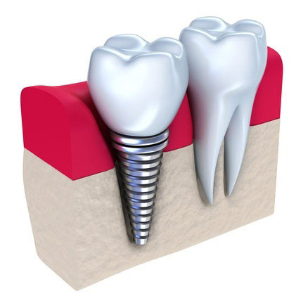 Dental Implants in Roseville, CA