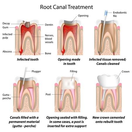 Root Canal Dentistry in California